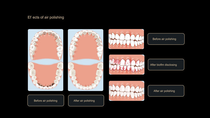 Woodpecker Dental Air Polisher AP-H Plus