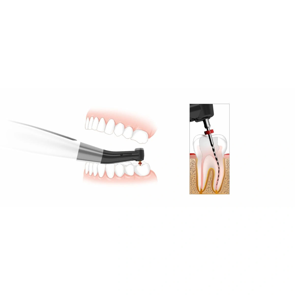 DTE CA 221 Woodpecker Endomatic Endo Motor Head